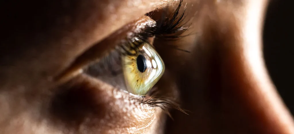 keratokonus tedavisi halka uygulaması