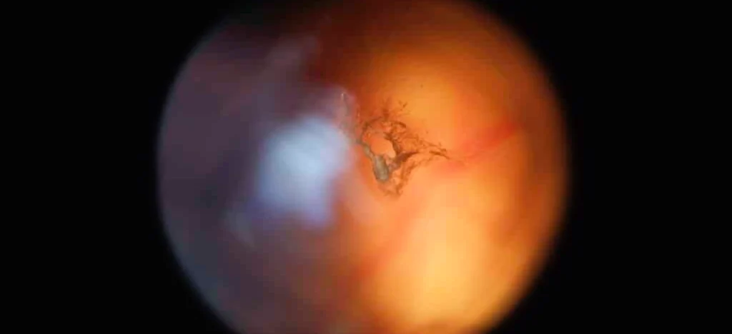 gözde uçuşan siyah noktalar