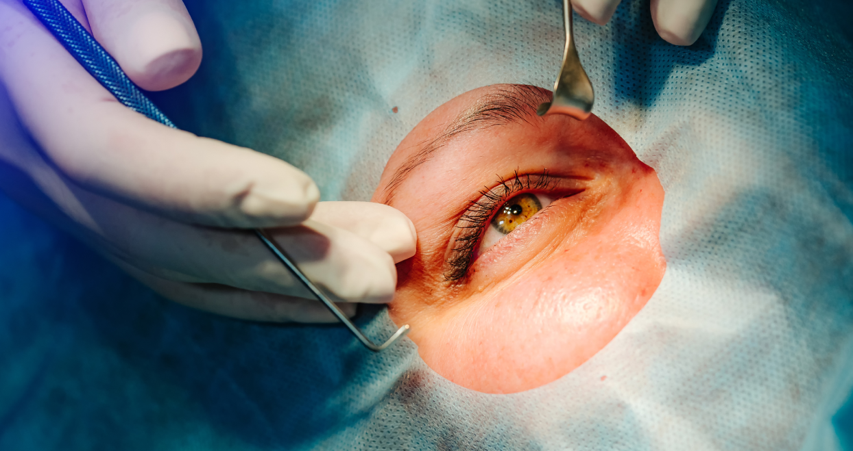 SMILE Lazer mi, LASIK mi? Farkları Neler?