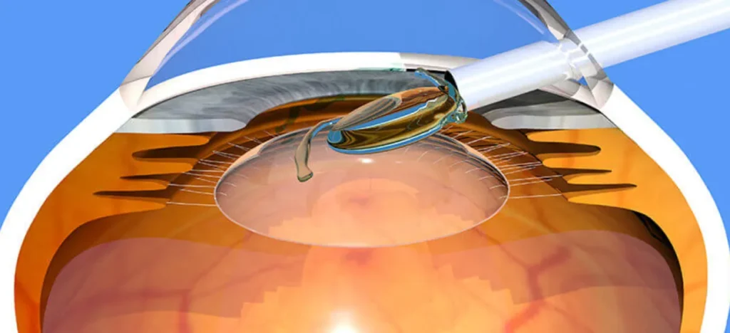 akıllı lens uygulaması