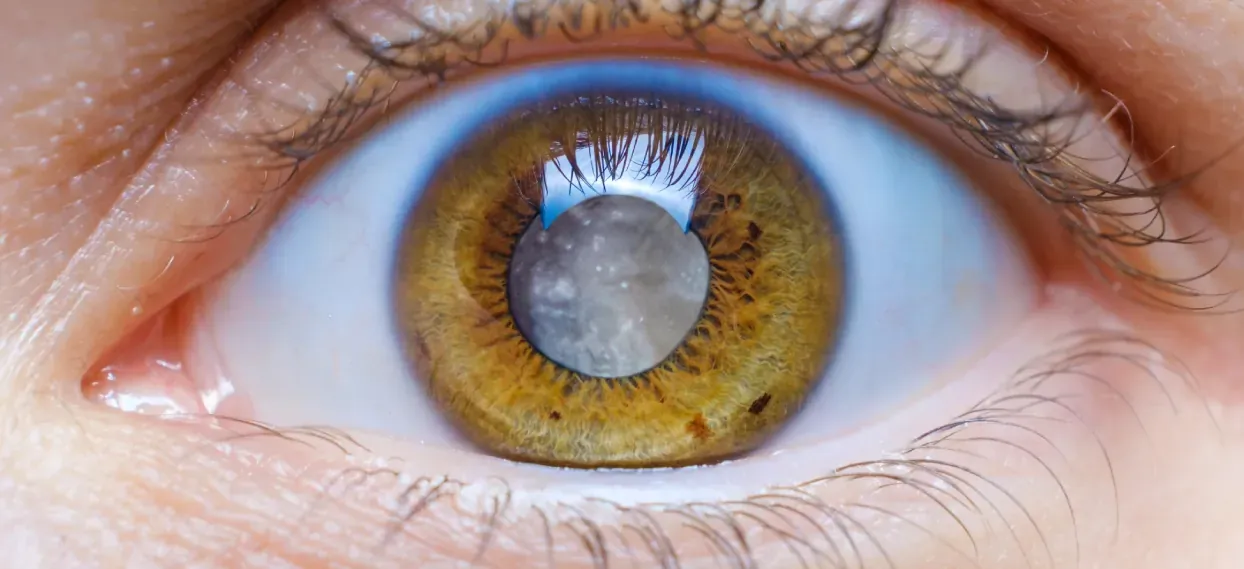 Cataract Surgery