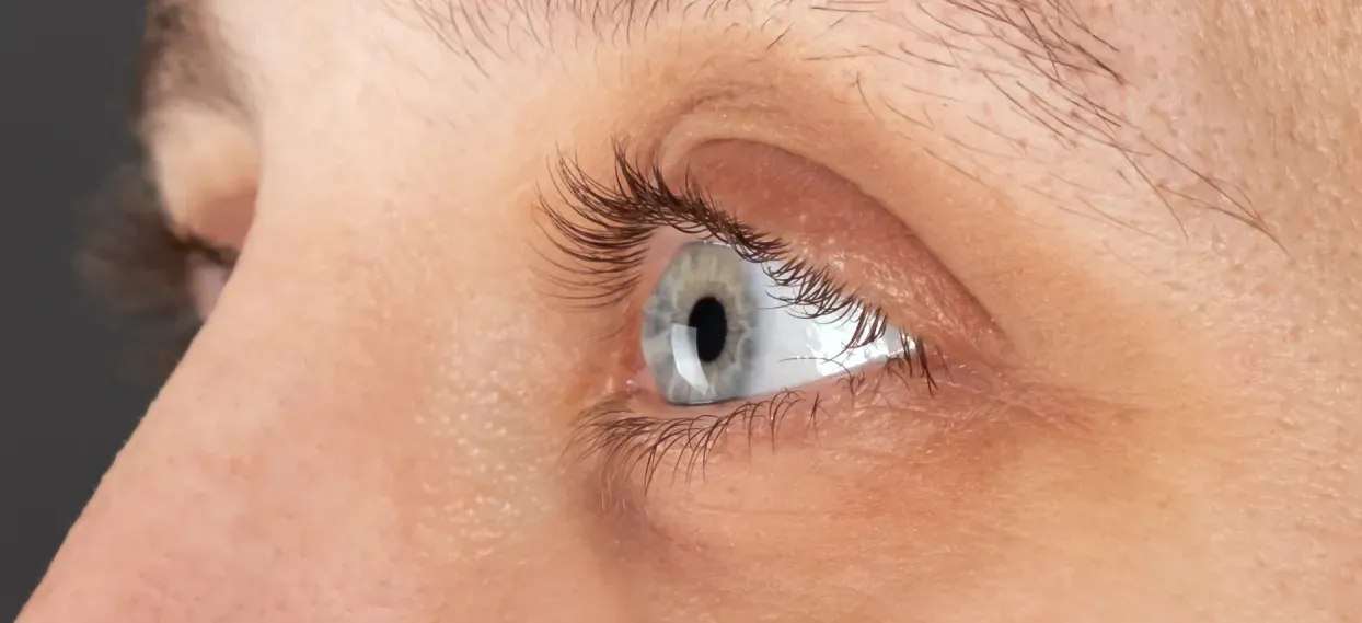 Keratoconus