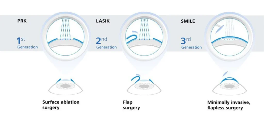 laser eye surgery
